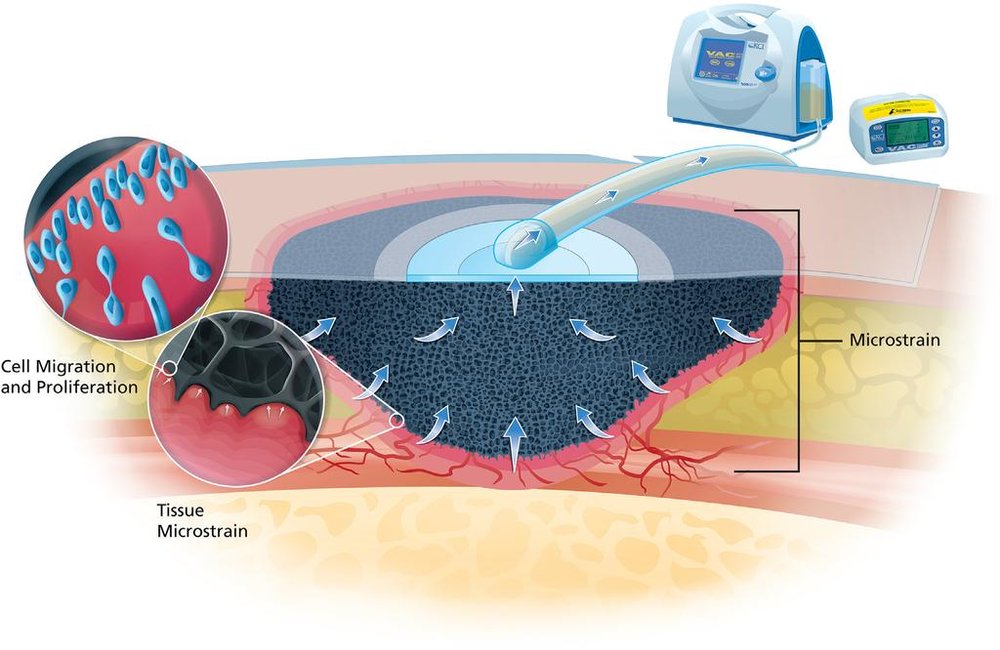 united-states-negative-pressure-wound-therapy-market-analysis-size