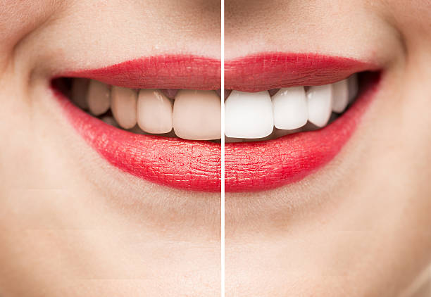 Teeth whitening sydney