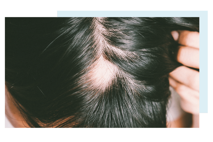 Understanding the Psychological Impact of the Fear of Hair Loss